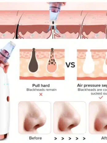 Vacuum Blackhead Remover for Face Pores and Black Spots