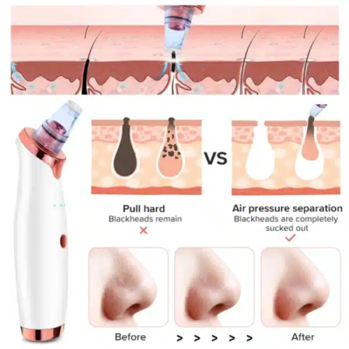Vacuum Blackhead Remover for Face Pores and Black Spots